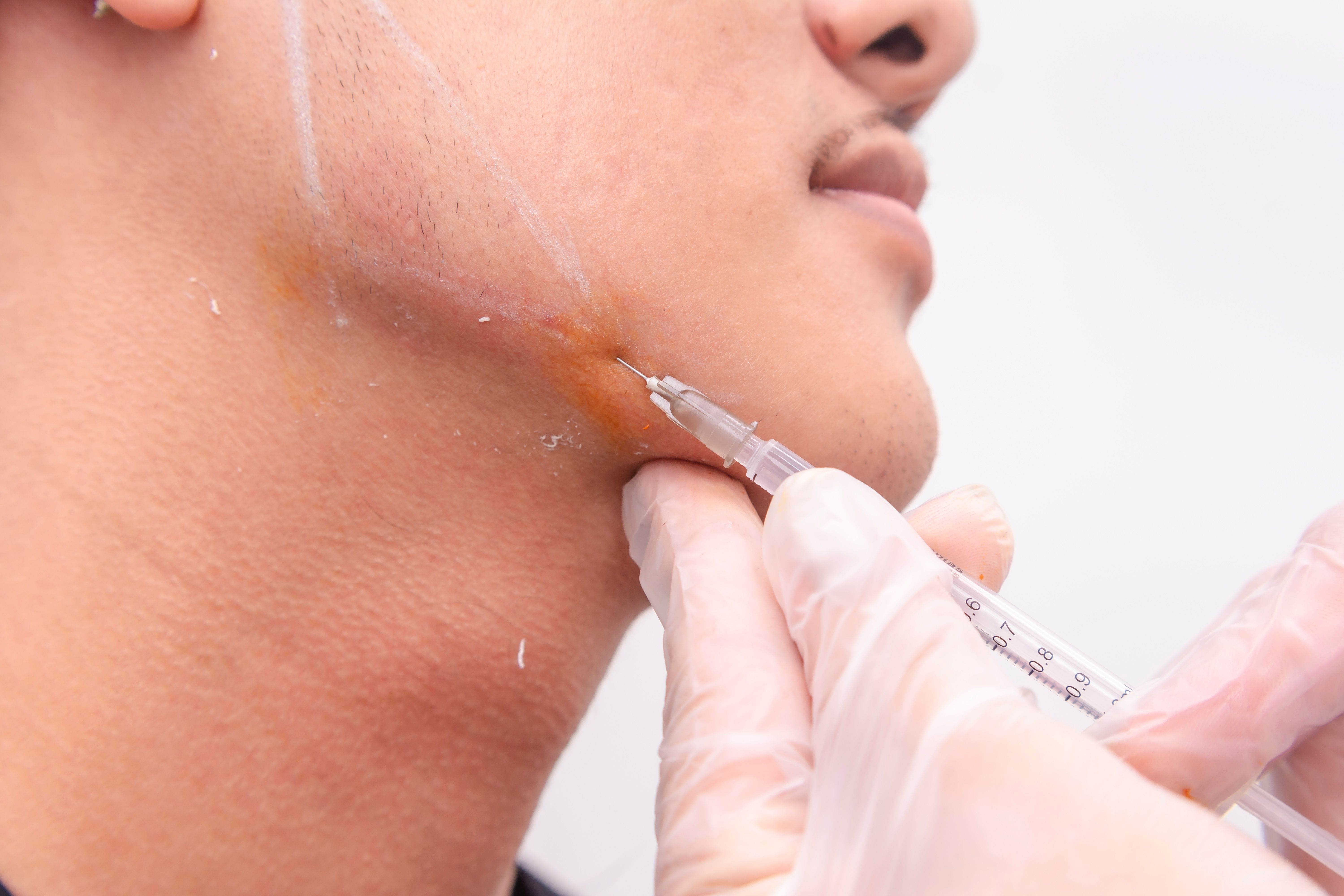 jawline-filler-procedure-for male-patient.jpg